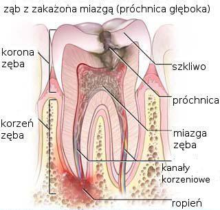 Głęboka próchnica zęba
