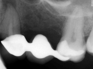endodoncja przed leczeniem