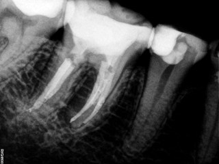 Po leczeniu endodontycznym