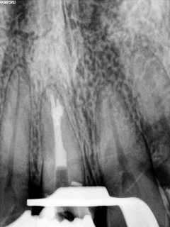 Ząb zaraz po leczeniu